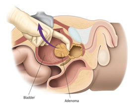 Prostatectomy